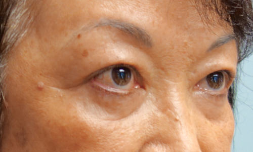 asian blepheroplasty patient side view