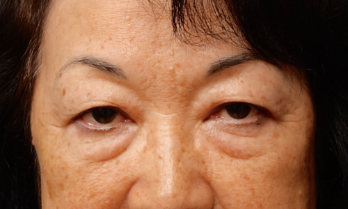 asian blepheroplasty patient front view