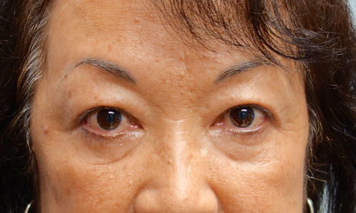 asian blepheroplasty patient front view