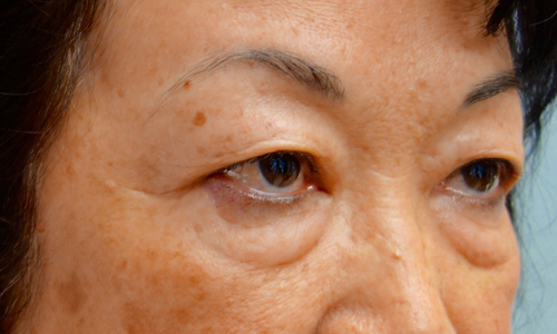 asian blepheroplasty patient side view