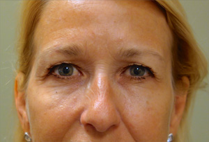 Botox After Photo Gallery Patient 2 Front Angle Dr. Joseph Infocus Inland Empire