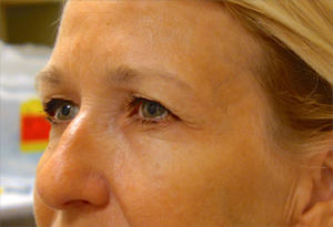 Botox After Photo Gallery Patient 2 Side Angle Dr. Joseph Infocus Inland Empire