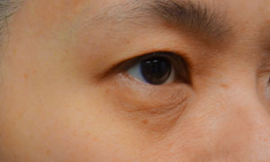 asian eyelid surgery patient side view