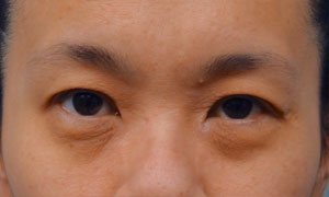 asian eyelid surgery patient front view