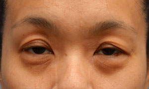 asian eyelid surgery patient front view