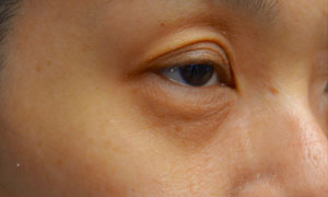 asian eyelid surgery patient side view