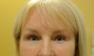 brow lift patient front view