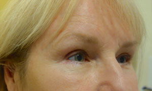 brow lift patient side view
