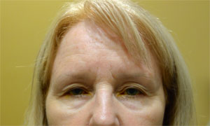 brow lift patient front view