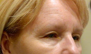 brow lift patient side view