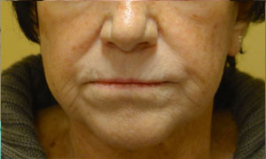Injectable fillers after pic front view