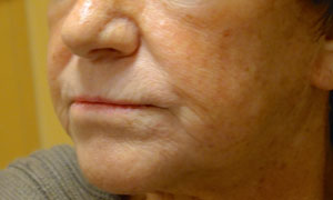 Injectable fillers after pic side view