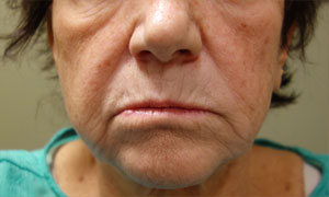 Injectable fillers for a patient before pic front view