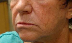 Injectable fillers for a patient before pic side view