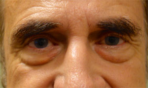 Lower eyelid blepheroplasty patient before pic front view