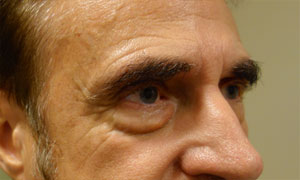 Lower eyelid blepheroplasty patient before pic side view