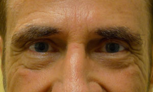 Lower eyelid blepheroplasty patient after pic front view