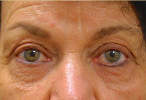 Ptosis Surgery Before Patient 5 After Front Angle Dr. Joseph Inland Empire
