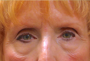 Ptosis Surgery Before Patient 5 After Front Angle Dr. Joseph Inland Empire