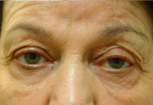 Ptosis Surgery Before Patient 5 After Front Angle Dr. Joseph Inland Empire