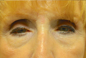 Ptosis Surgery Before Patient 5 Front Angle Dr. Joseph Inland Empire