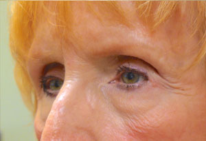 Ptosis Surgery After Patient 5 Side Angle Dr. Joseph Inland Empire