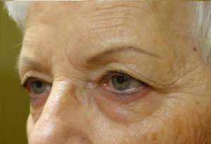 Ptosis Surgery Before Patient 5 After Side Angle Dr. Joseph Inland Empire