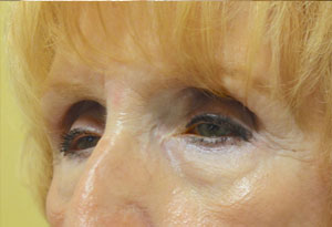 Ptosis Surgery Before Patient 5 Side Angle Dr. Joseph Inland Empire