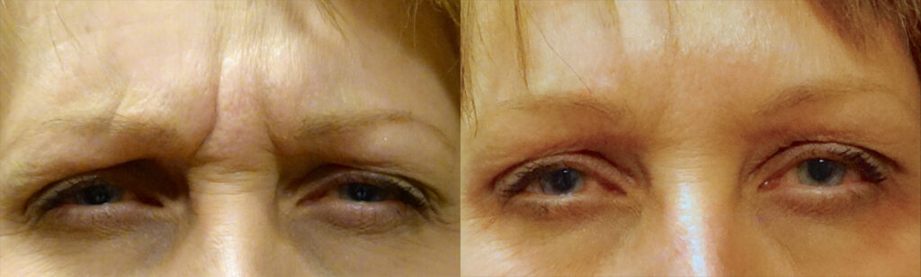 Injectable Filler Patient-5