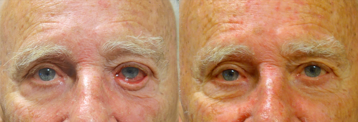 Entropion Before and After Photo Gallery Patient 4 Front Angle Dr. Joseph Infocus Inland Empire