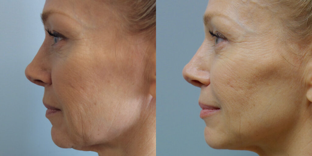 Non surgical Facelift