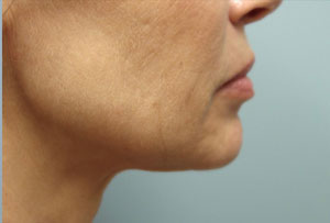 Non Surgical Facelift After Photo Gallery Lower Side Angle Dr. Joseph Infocus Inland Empire