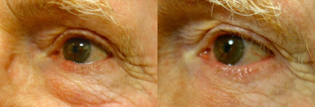 Eyelid Growth Patient-4