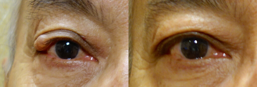 Eyelid Growth Patient-6