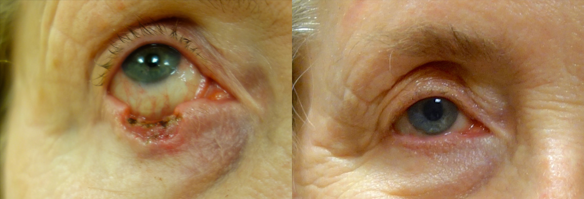 Massive Eyelid Skin Cancer Defect Before And After Reconstruction My