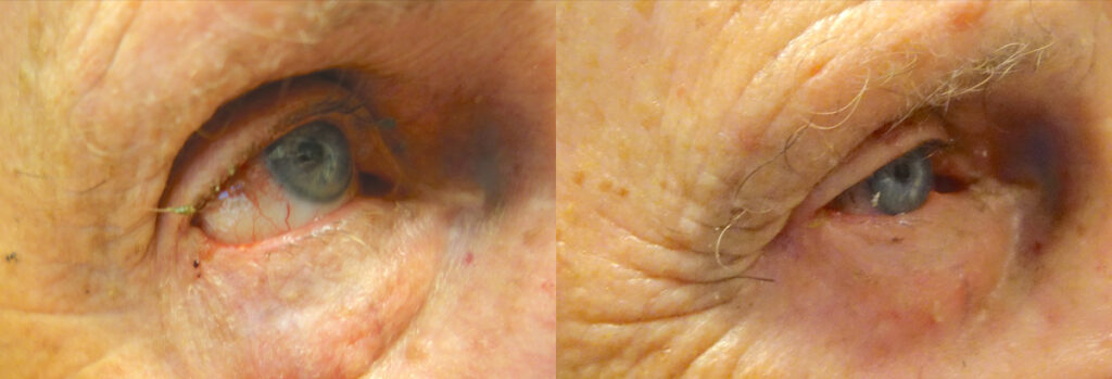 Eyelid Skin Cancer Patient-10