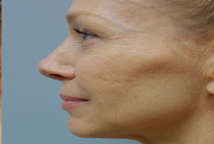 Non Surgical Facelift After Photo Gallery Side Angle Dr. Joseph Infocus Inland Empire