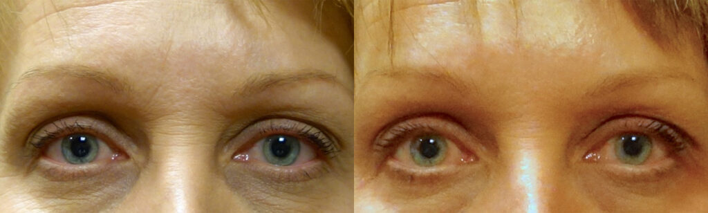 Injectable Filler Patient-5