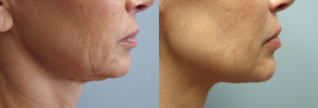 Non surgical Facelift