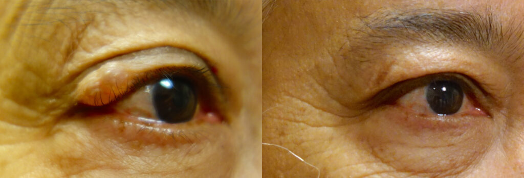 Eyelid Growth Patient-6
