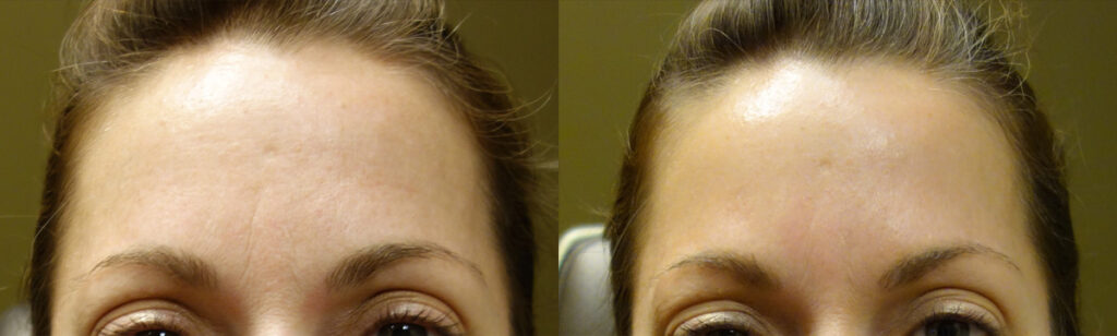 Injectable Filler Patient-6
