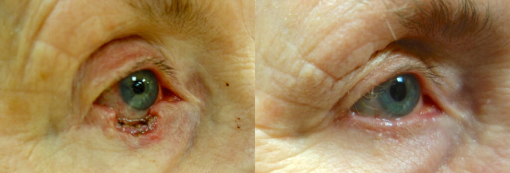 Eyelid Skin Cancer Patient-9