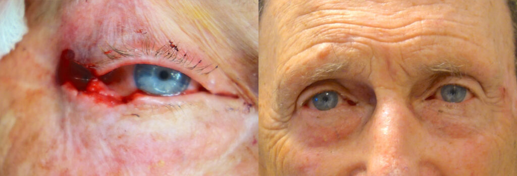 Eyelid Skin Cancer Patient-10