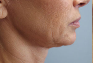 Non Surgical Facelift Before Photo Gallery Lower Side Angle Dr. Joseph Infocus Inland Empire