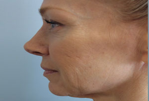 Non Surgical Facelift Before Photo Gallery Side Angle Dr. Joseph Infocus Inland Empire