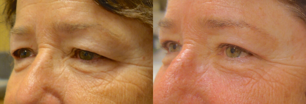 Upper Eyelid Patient-10