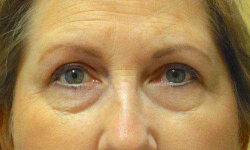 upper eyelid blepharoplasty patient after pic front view