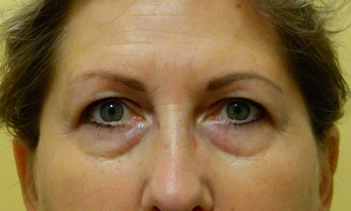 upper eyelid blepharoplasty patient before pic front view