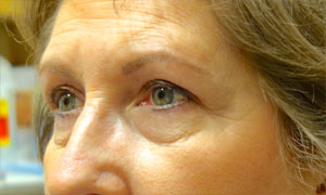 upper eyelid blepharoplasty patient after pic side view