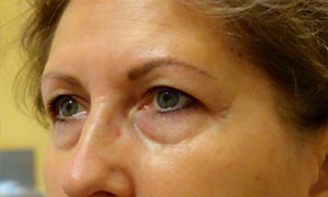 upper eyelid blepharoplasty patient before pic side view